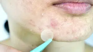 علت جوش صورت